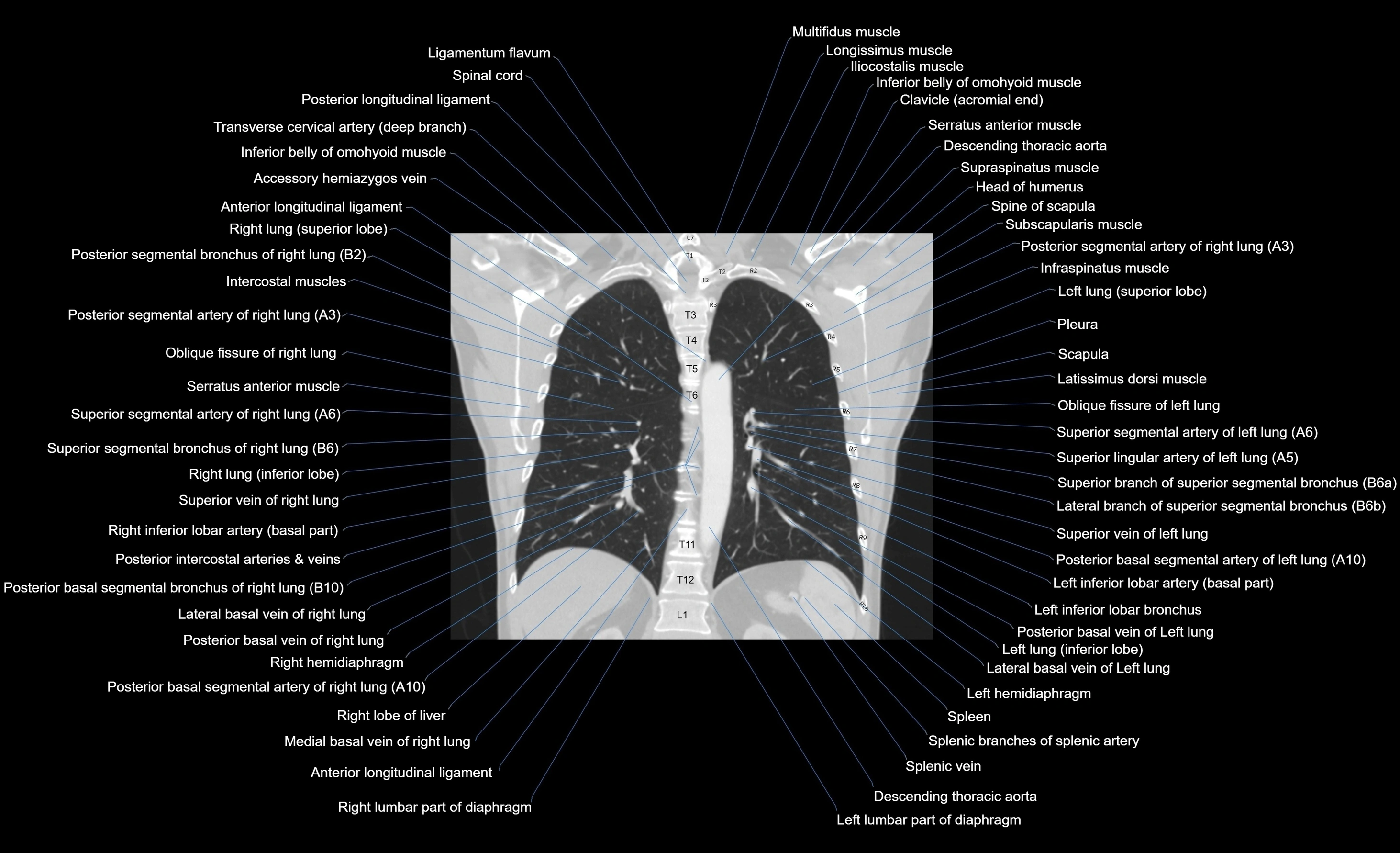 CT chest (thorax) lung window window labelled coronal cross sectional anatomy radiology image-00044.webp